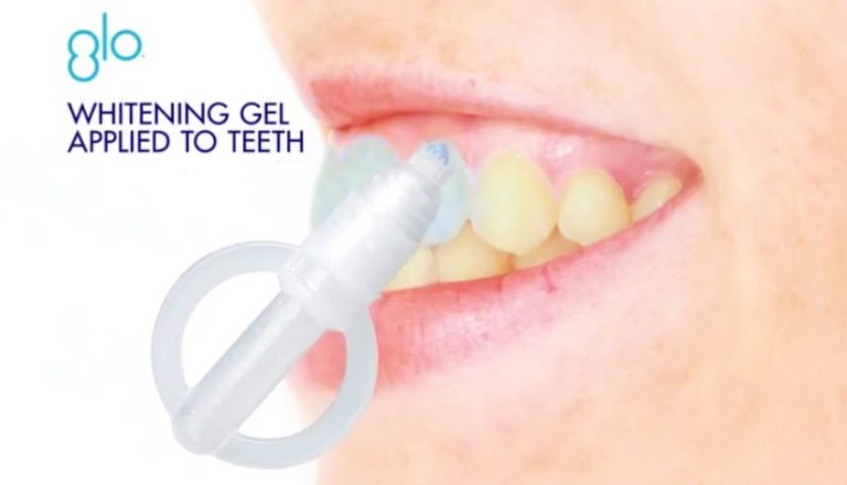 GLO Science is a Trendy New Teeth Whitening Service ...