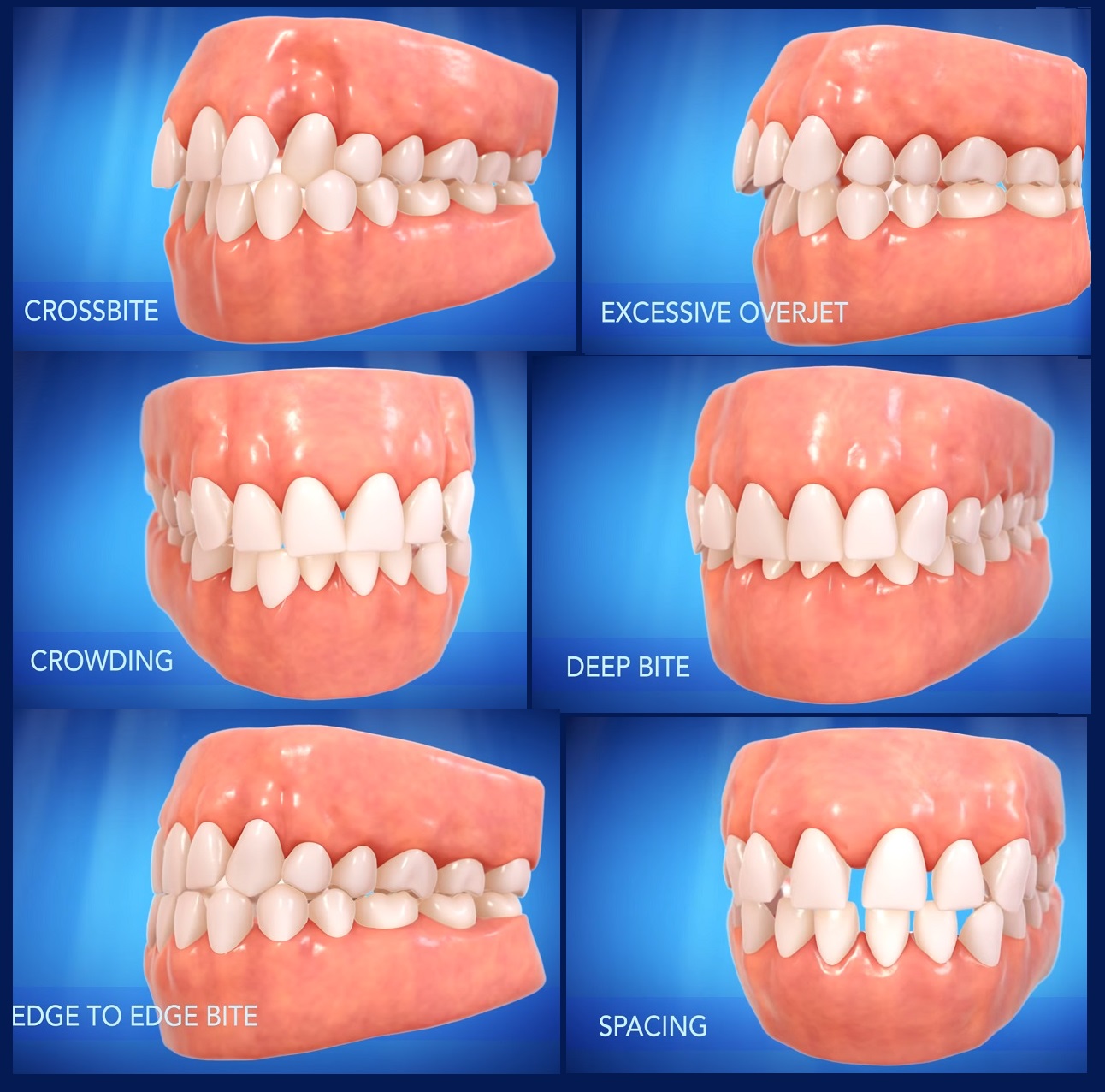 Invisalign vs Braces – Langley Family Dentistry