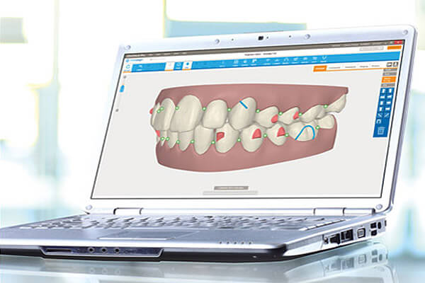 Align Technology on X: #AlignTech is excited to announce the launch of a  digital treatment facility in Spain, which will play an important role in  providing local support to Invisalign trained doctors
