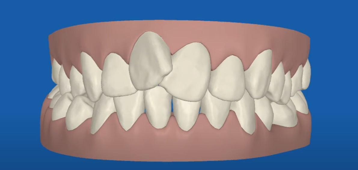 If Invisalign is Supposed to Be Invisible, What Are These Attachments For?